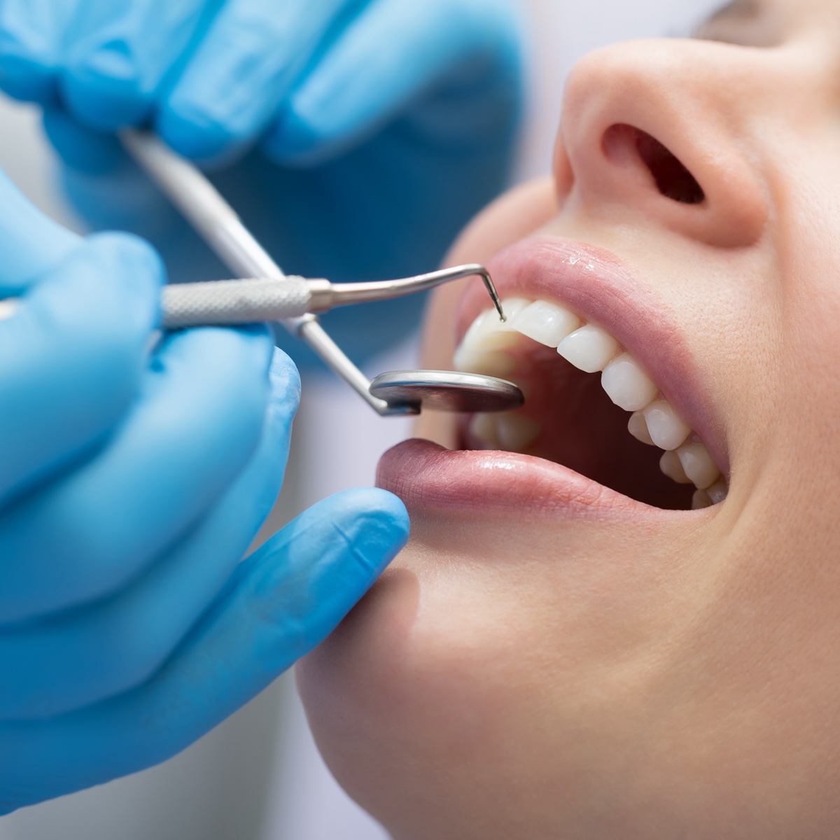 Dental Crowns and Bridges - Expert dental services in Hungary - Access-Smile